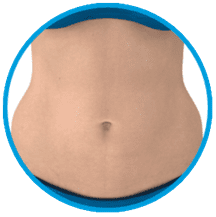 EMSculpt Abdomen Treatment Area