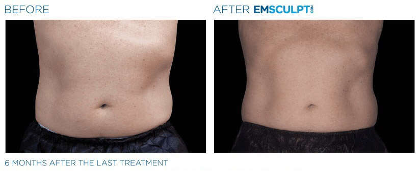 Before and after EMSCULPT