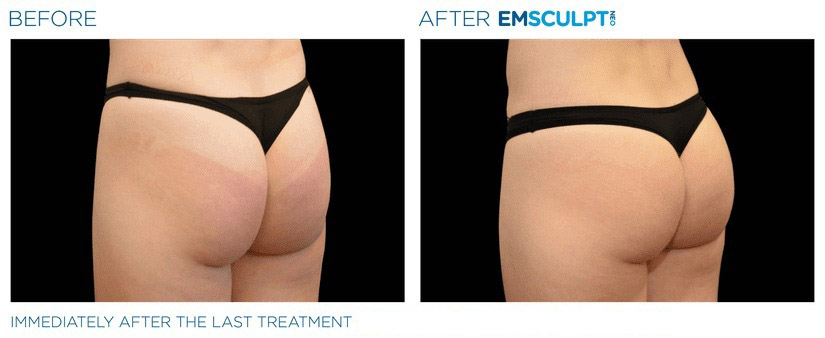 Before and after EMSCULPT