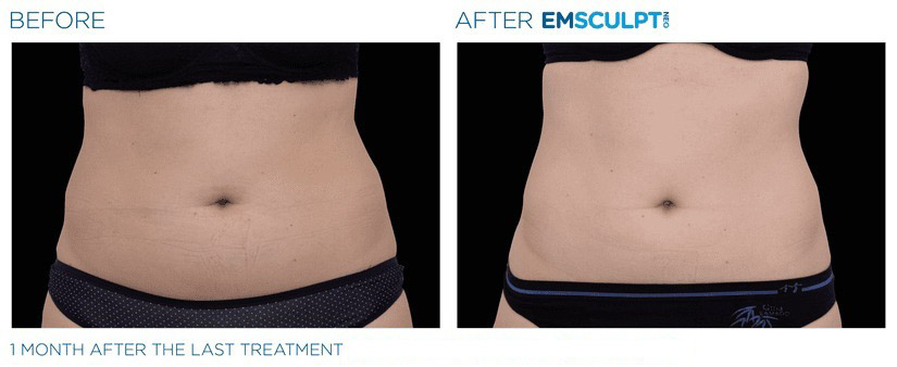 Before and after EMSCULPT