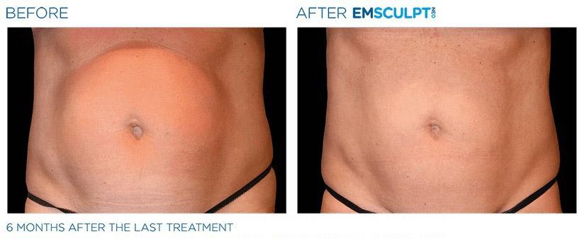 Before and after EMSCULPT