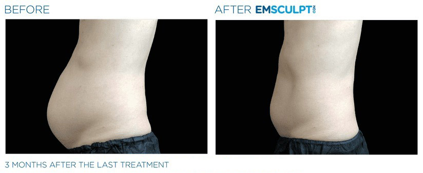 Before and after EMSCULPT